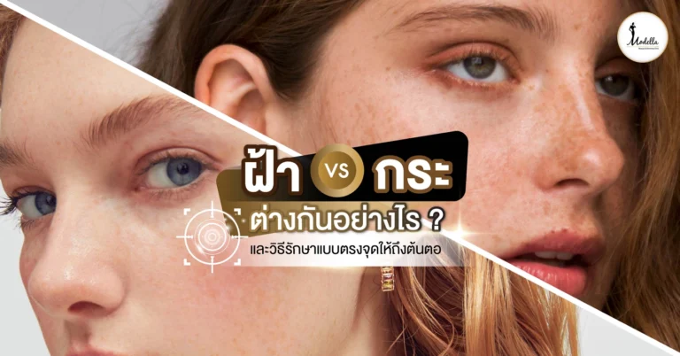 ฝ้า กระ ต่างกันอย่างไร ? และวิธีรักษาแบบตรงจุดให้ถึงต้นตอ