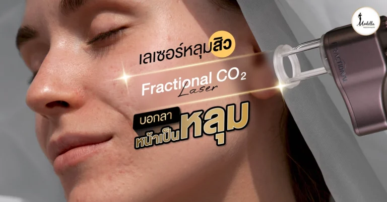 เลเซอร์หลุมสิว Fractional CO2 Laser บอกลาหน้าเป็นหลุม