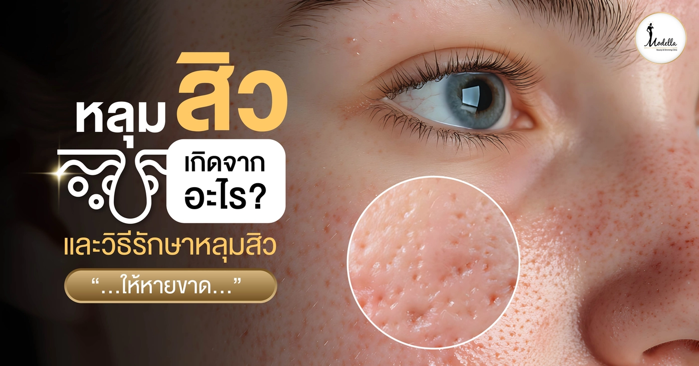 หลุมสิว เกิดจากอะไร และวิธีรักษาหลุมสิวให้หายขาด
