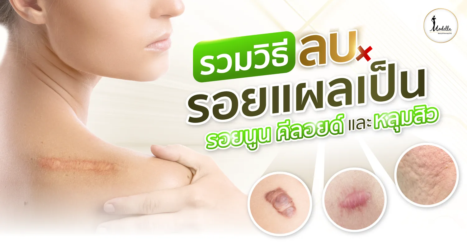 รวมวิธีลบรอยแผลเป็น ทั้งรอยนูน คีลอยด์ และหลุมสิว ให้จางลงอย่างได้ผล
