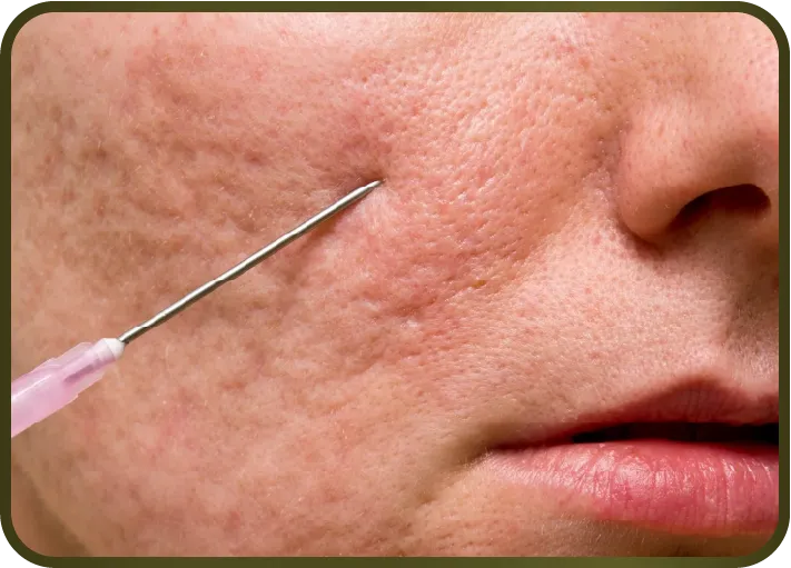 การตัดพังผืดใต้แผล (Subcision)