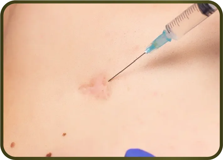 การฉีดสเตียรอยด์ (Corticosteroid Injection)