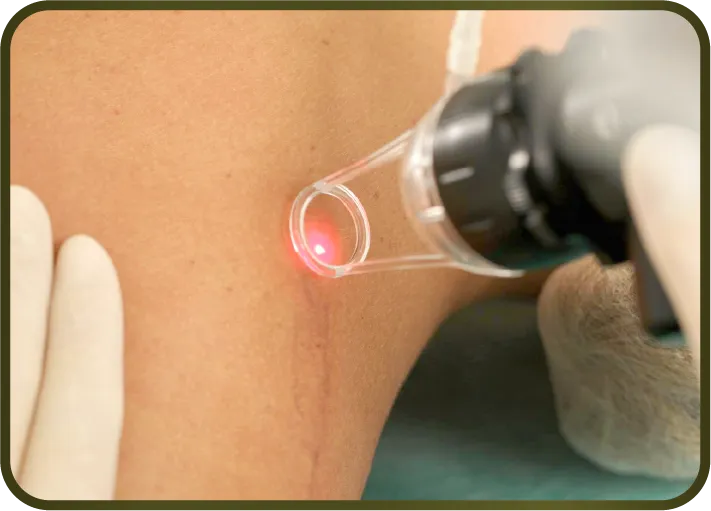 การใช้เลเซอร์ (Laser Treatment)