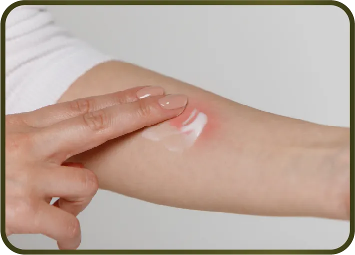 ทาครีมลด รอยแผลเป็น (Topical products)