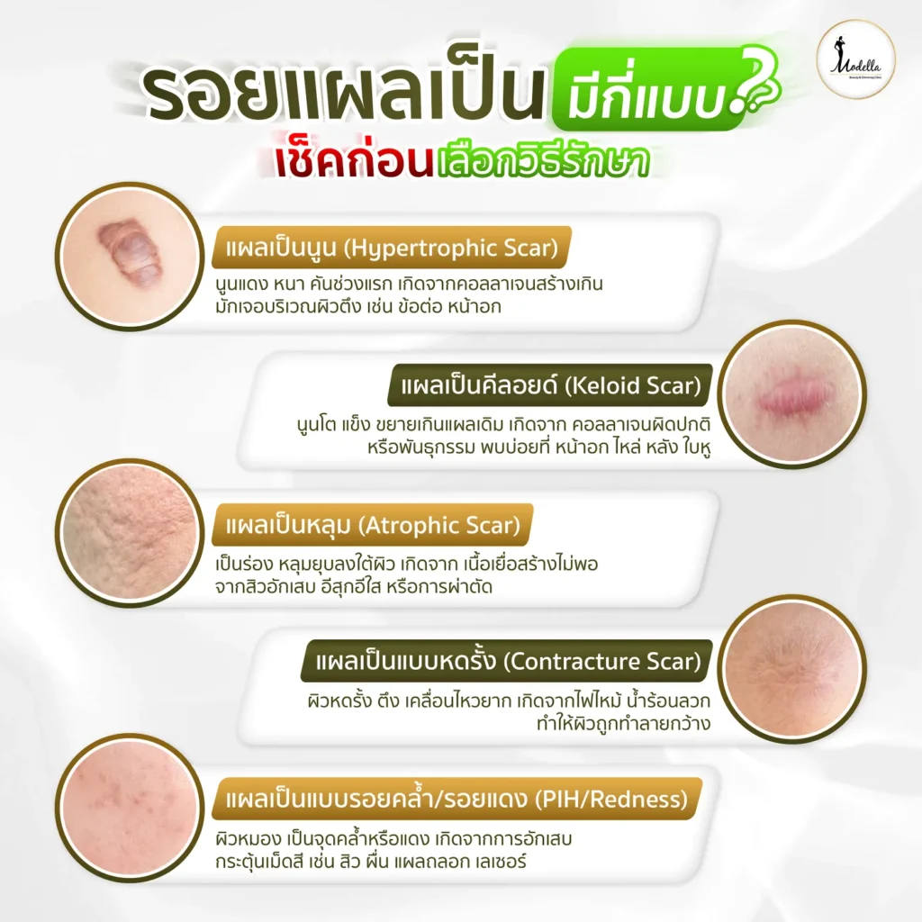 รอยแผลเป็น มีกี่แบบ? เช็กให้รู้ ก่อนเลือกวิธีรักษา