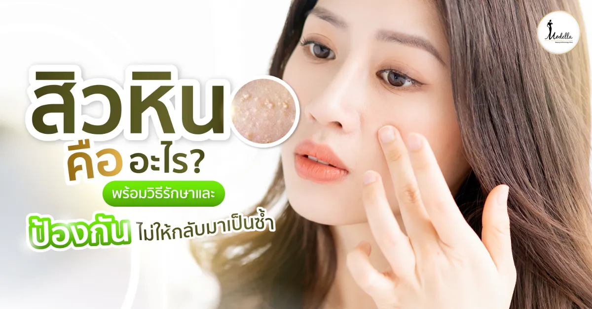สิวหินคืออะไร? พร้อมวิธีรักษาและป้องกันไม่ให้กลับมาเป็นซ้ำ