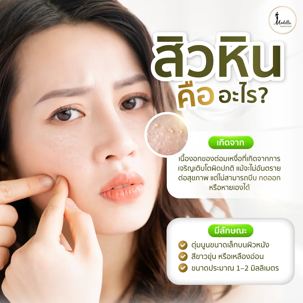 สิวหิน (Syringoma)