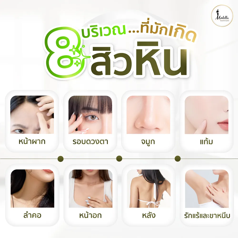 8 บริเวณที่มักเกิดสิวหิน