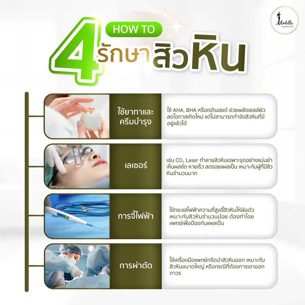 4 How to รักษาสิวหิน