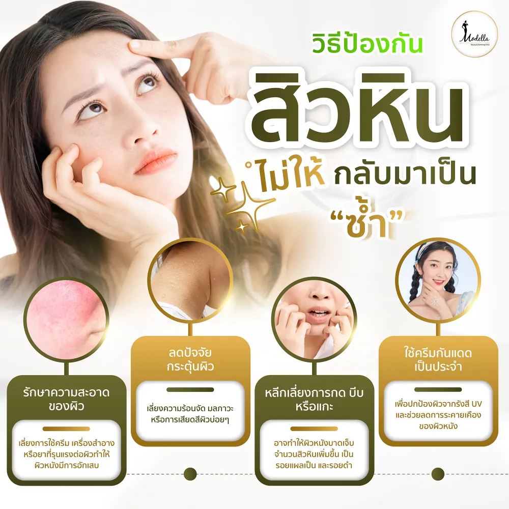 วิธีป้องกัน สิวหิน ไม่ให้กลับมาเป็นซ้ำ