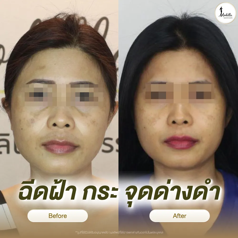 รีวิวฉีดฝ้า กระ จุดด่างดำ