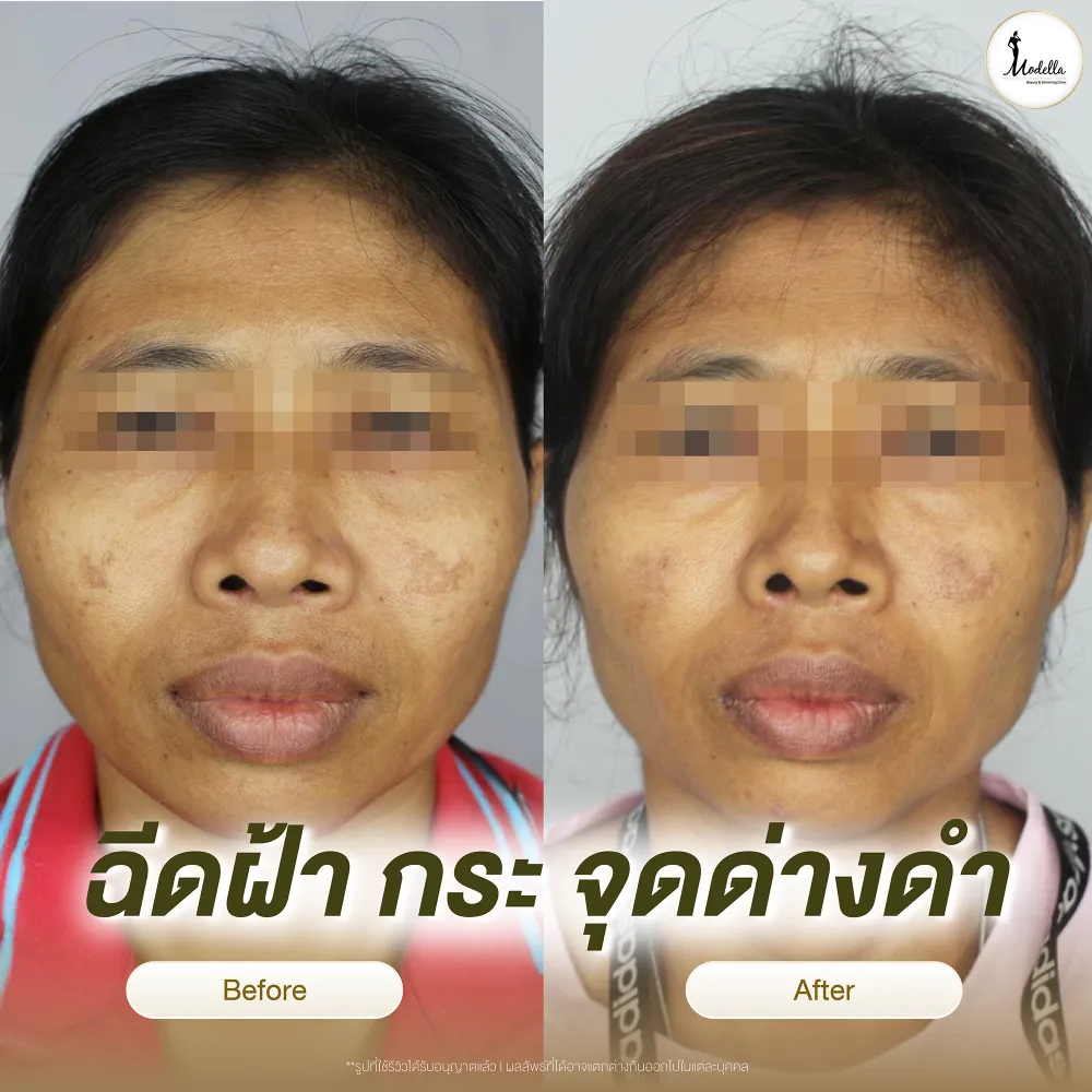 รีวิวฉีดฝ้า กระ จุดด่างดำ