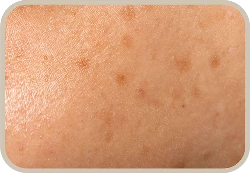 จุดด่างดำ (Dark spot)