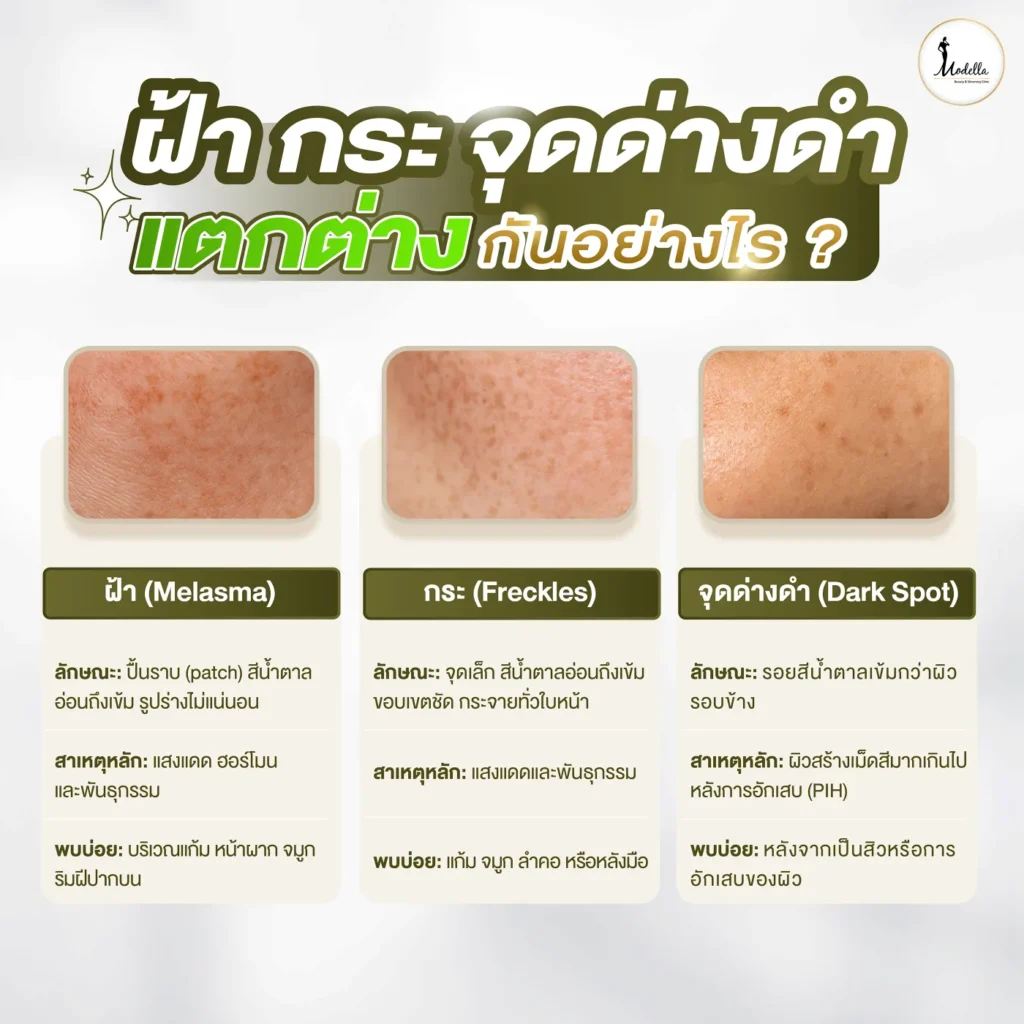 ฝ้า กระ จุดด่างดำ แตกต่างกันอย่างไร