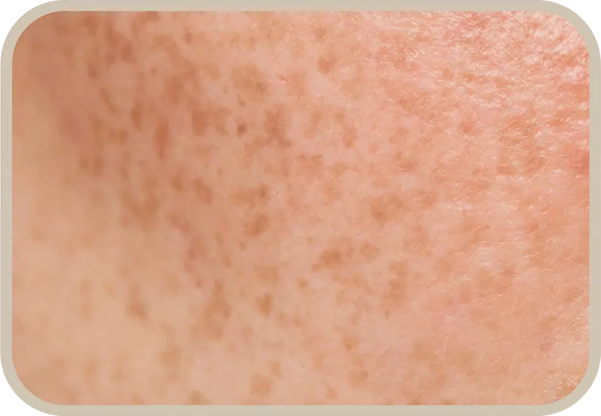 กระ (Freckles)