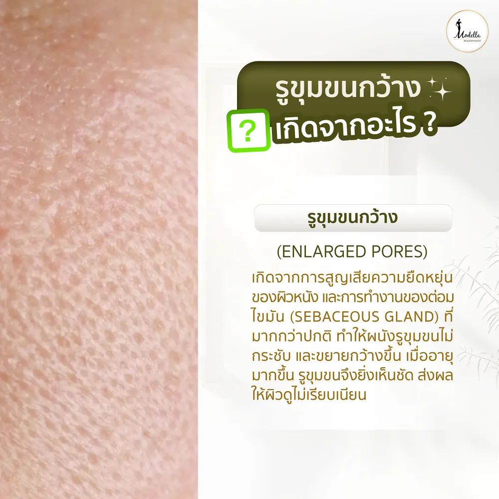 รูขุมขนกว้าง เกิดจากอะไร ?