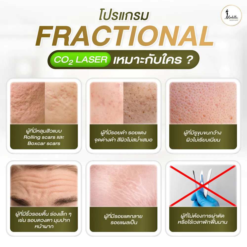 โปรแกรมFractional CO2 Laser เหมาะกับใครบ้าง ?