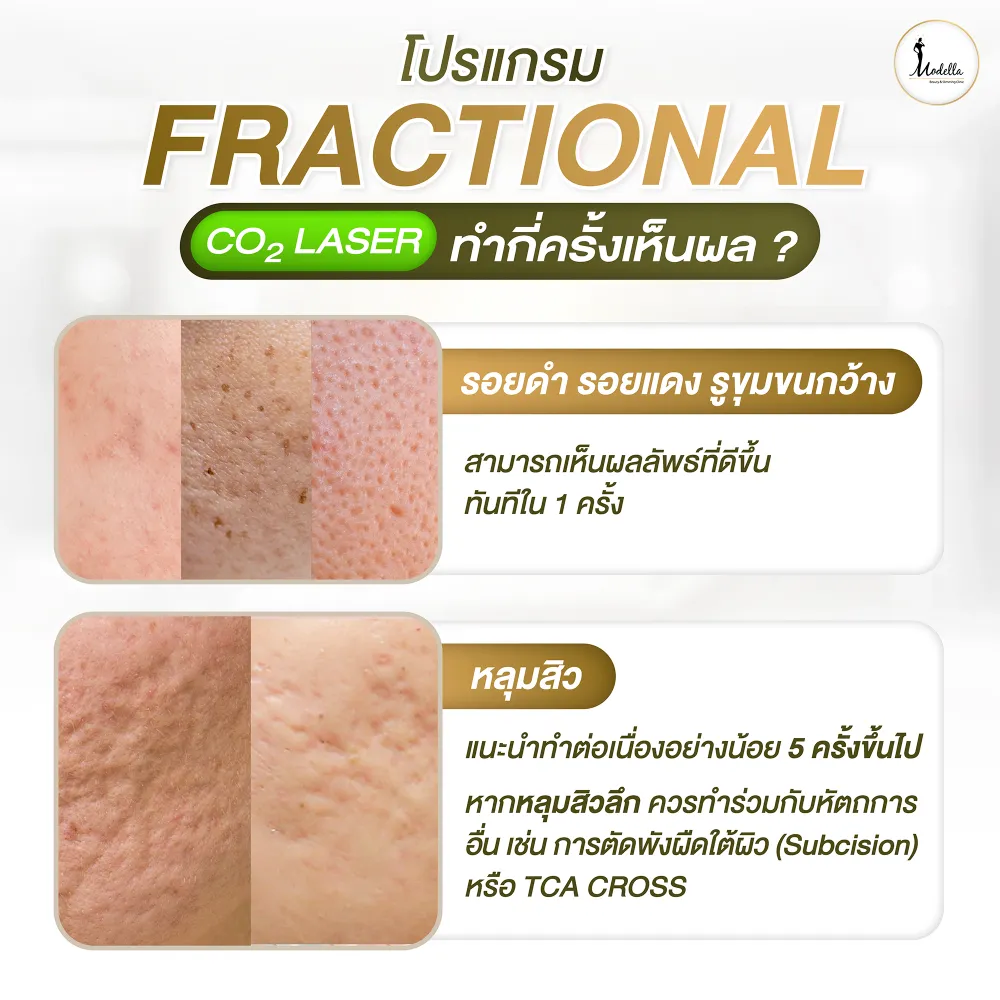โปรแกรมFractional CO2 Laser ทำกี่ครั้งเห็นผล?