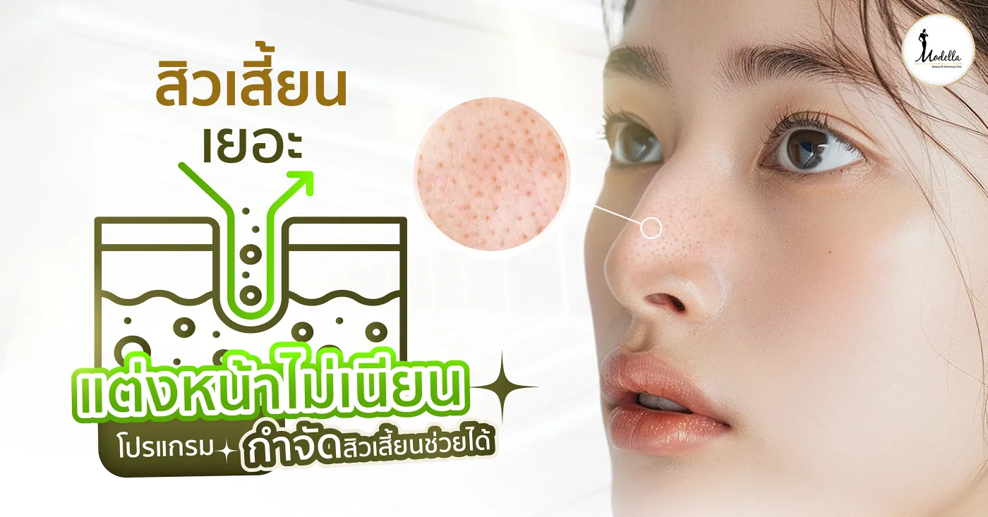 สิวเสี้ยนเยอะ แต่งหน้าไม่เนียน โปรแกรมกำจัดสิวเสี้ยนช่วยได้