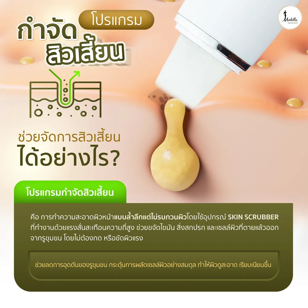 โปรแกรมกำจัดสิวเสี้ยน ช่วยจัดการสิวเสี้ยนได้อย่างไร?