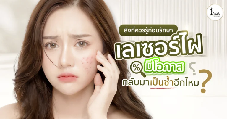 เลเซอร์ไฝ มีโอกาสกลับมาเป็นซ้ำอีกไหม? สิ่งที่ควรรู้ก่อนรักษา