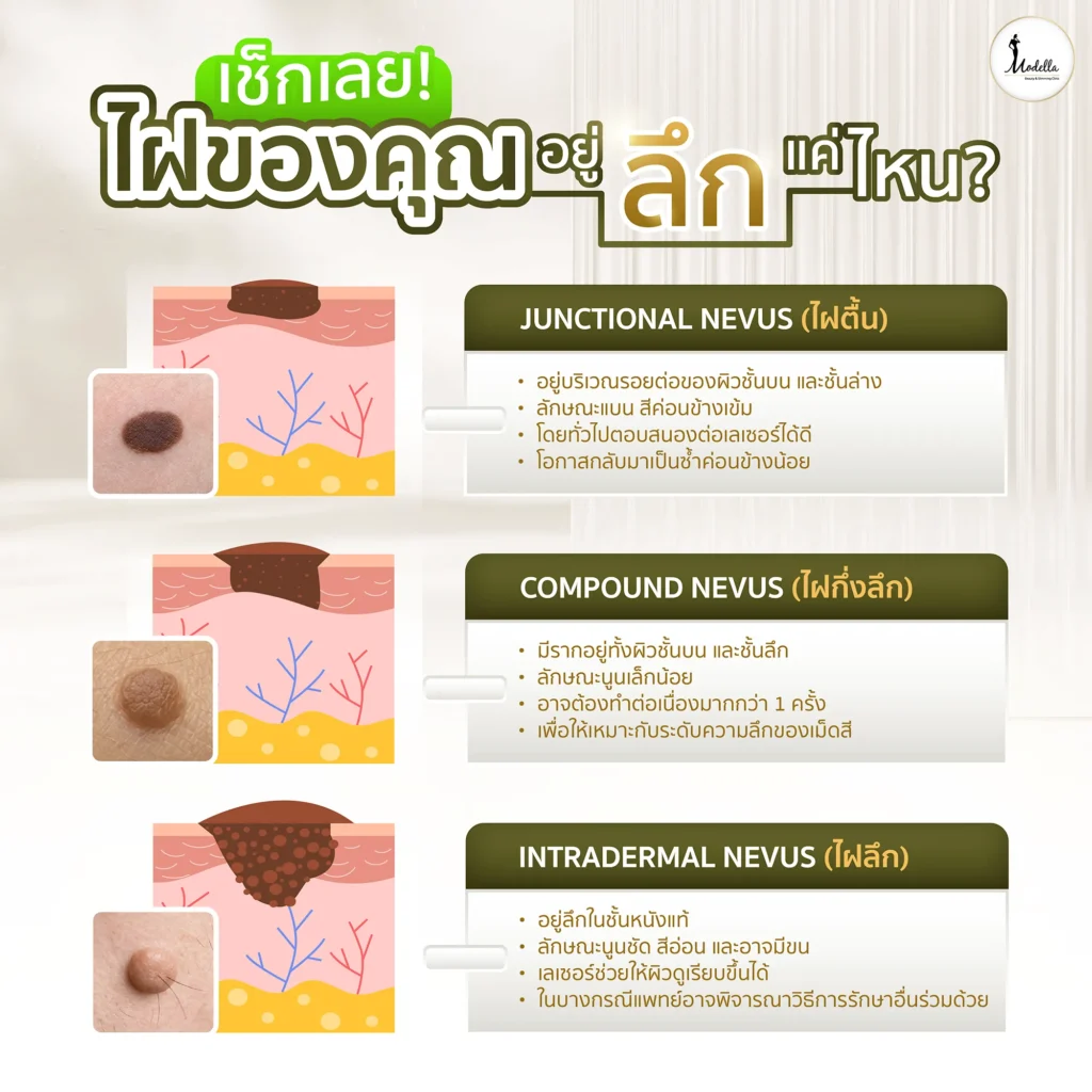 ไฝของคุณ อยู่ลึกแค่ไหน ?