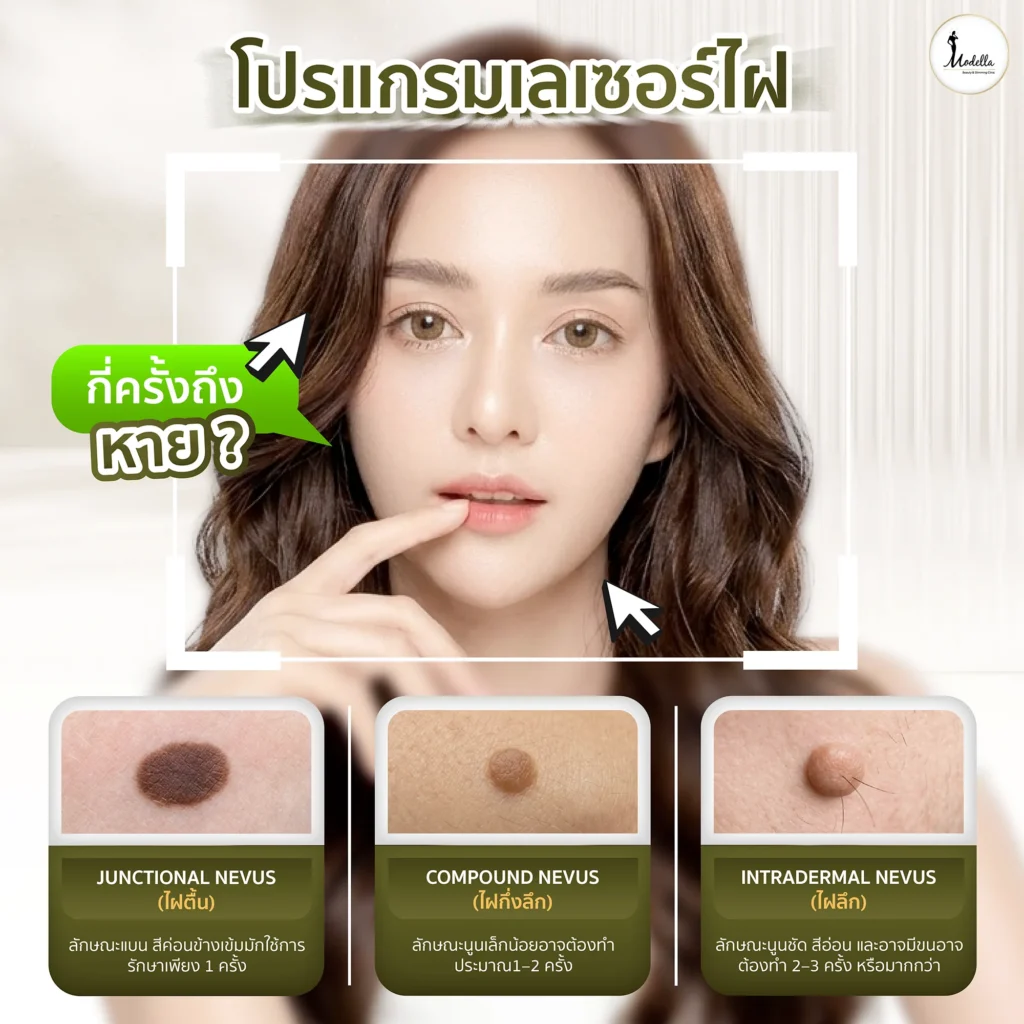 โปรแกรมเลเซอร์ไฝ กี่ครั้งถึงหาย ?