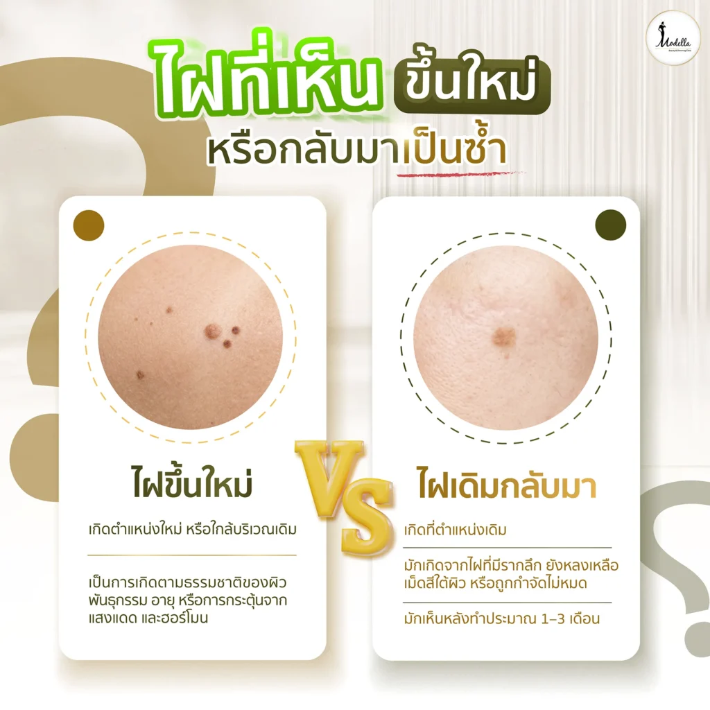ไฝที่เห็นขึ้นใหม่ หรือกลับมาเป็นซ้ำ?