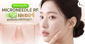 รักษาหลุมสิว Microneedle RF vs เลเซอร์ แบบไหนเหมาะกับผิวคุณ?