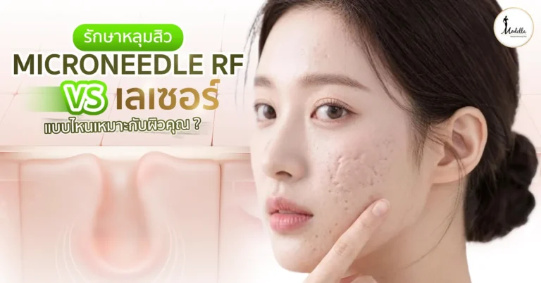 รักษาหลุมสิว Microneedle RF vs เลเซอร์ แบบไหนเหมาะกับผิวคุณ?