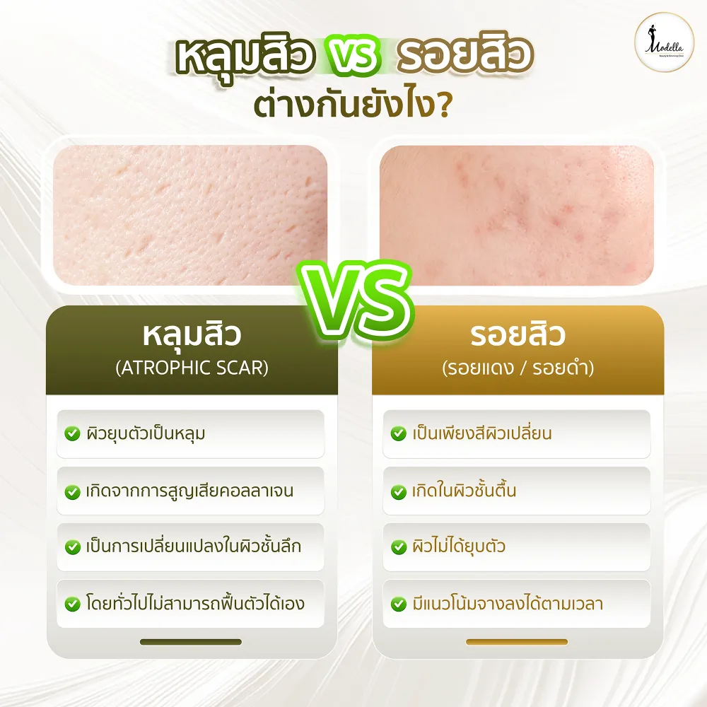 หลุมสิว vs รอยสิว ต่างกันยังไง? 