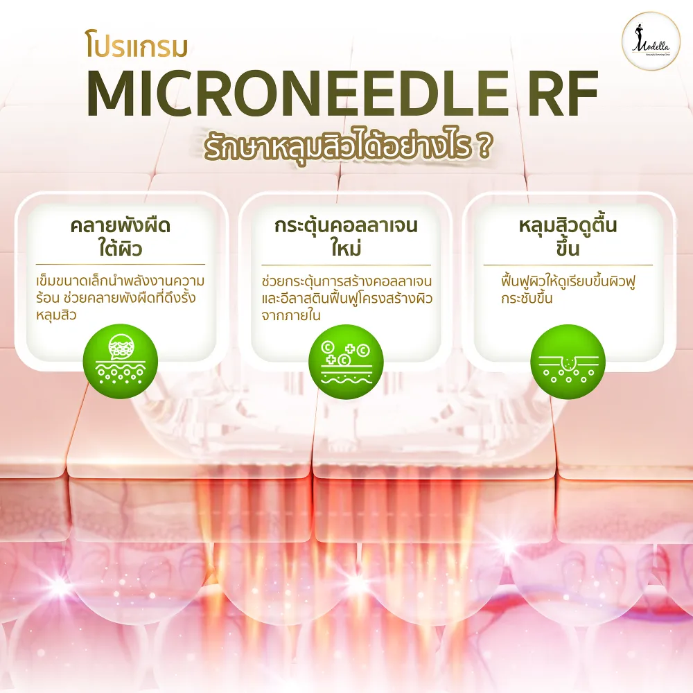 โปรแกรม Microneedle RF รักษาหลุมสิวได้อย่างไร ?