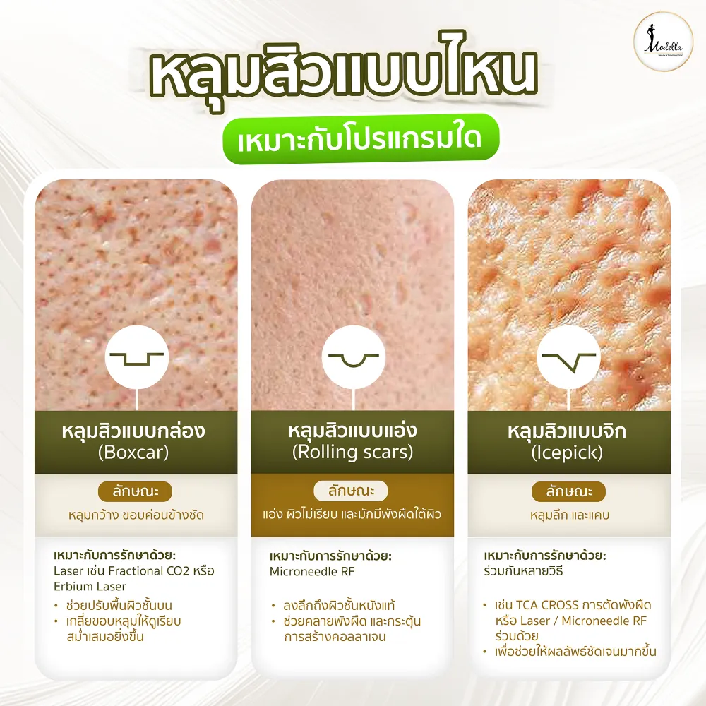 หลุมสิวแบบไหน เหมาะกับโปรแกรมใด