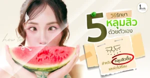 5 วิธีรักษาหลุมสิวด้วยตัวเอง ให้ผิวเรียบเนียนขึ้น