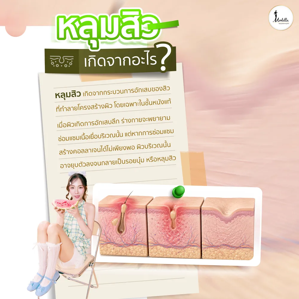 หลุมสิว เกิดจากอะไร ?