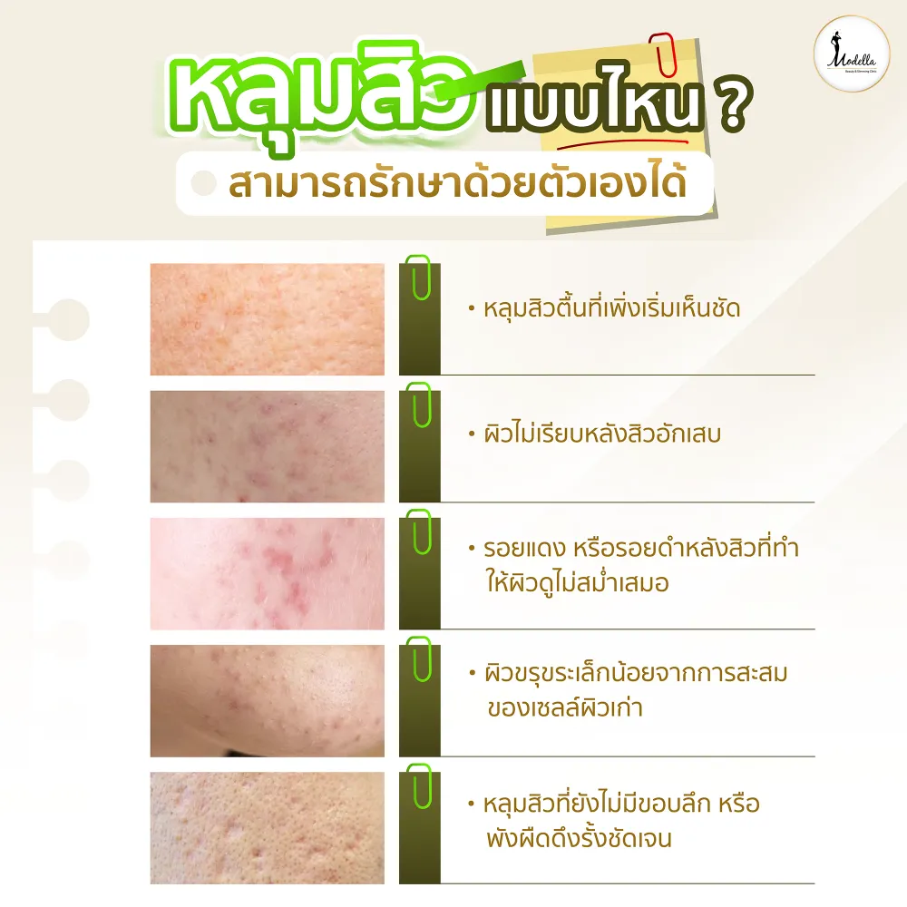 หลุมสิวแบบไหน ? สามารถรักษาด้วยตัวเองได้