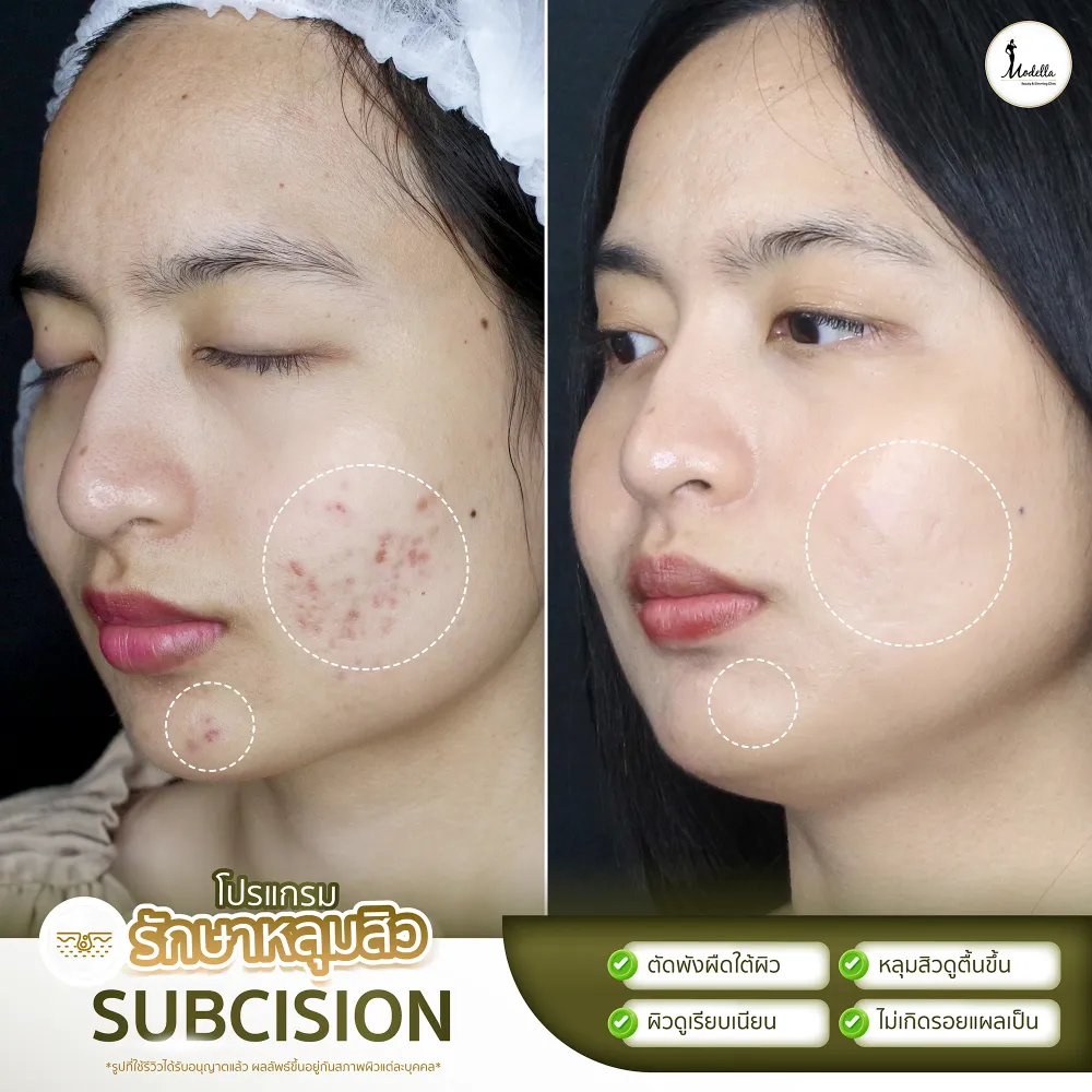 รีวิวผลลัพธ์โดยรวมหลังทำ Subcision