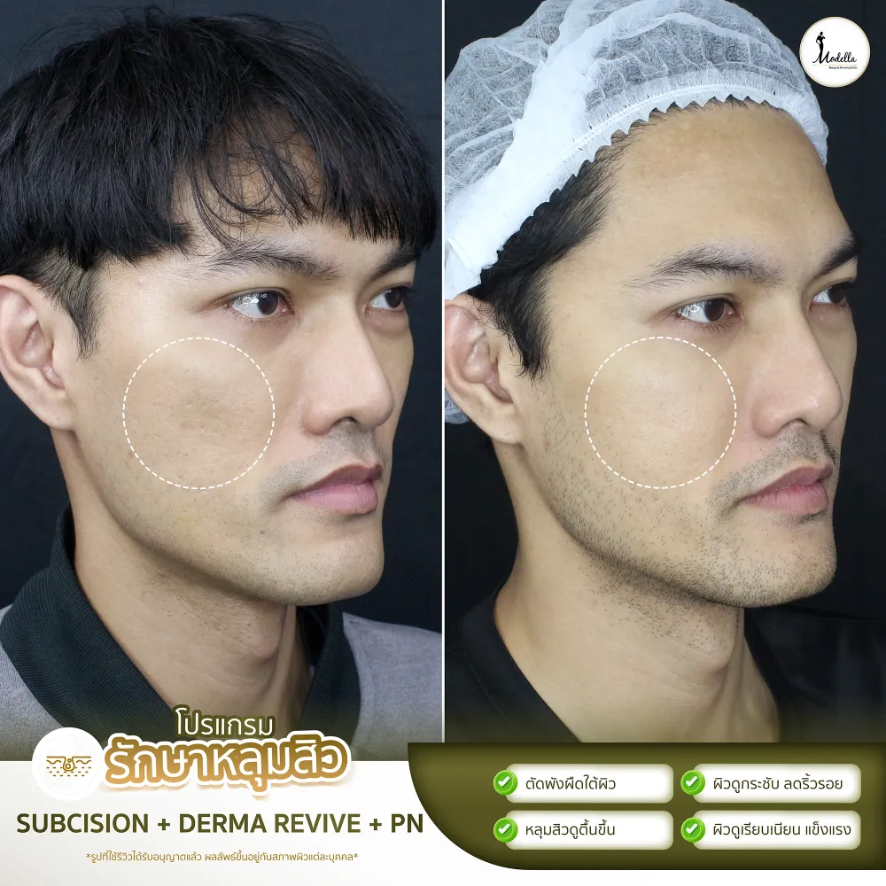 รีวิวผลลัพธ์โดยรวมหลังทำ Subcision