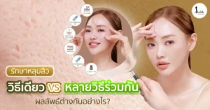 รักษาหลุมสิว วิธีเดียว vs หลายวิธีร่วมกัน ผลลัพธ์ต่างกันอย่างไร?