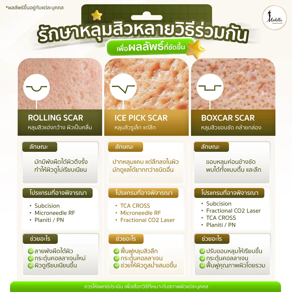 ตัวอย่างแนวทางการรักษาหลุมสิวแบบหลายวิธี