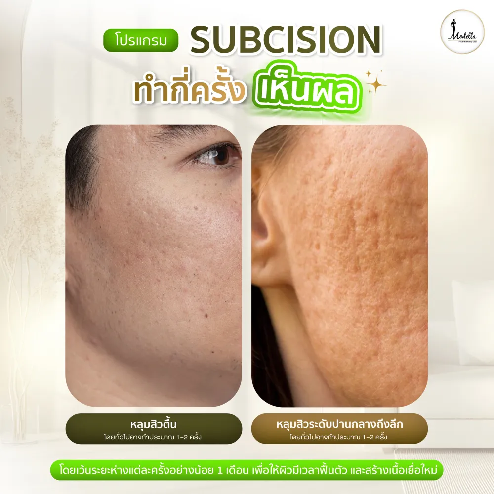 โปรแกรม Subcision ทำกี่ครั้งเห็นผล?