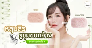 หลุมสิวกับรูขุมขนกว้าง ต่างกันอย่างไร?