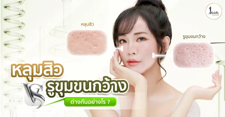 หลุมสิวกับรูขุมขนกว้าง ต่างกันอย่างไร?