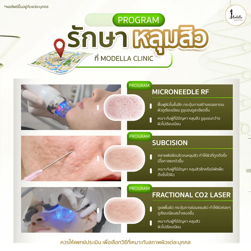 โปรแกรมรักษาหลุมสิวและดูแลรูขุมขน ที่ Modella Clinic 