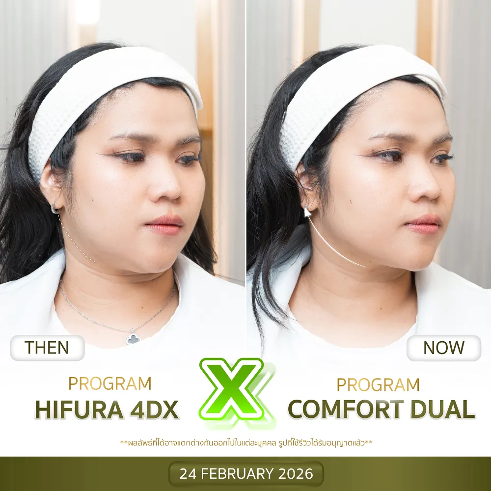 รีวิวผลลัพธ์หลังทำ HIFU และ Bipolar RF