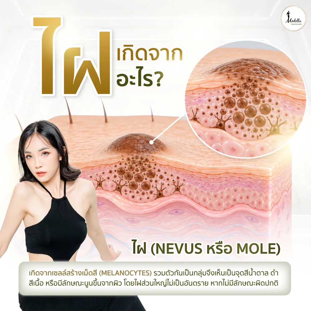 ไฝเกิดจากอะไร? 
