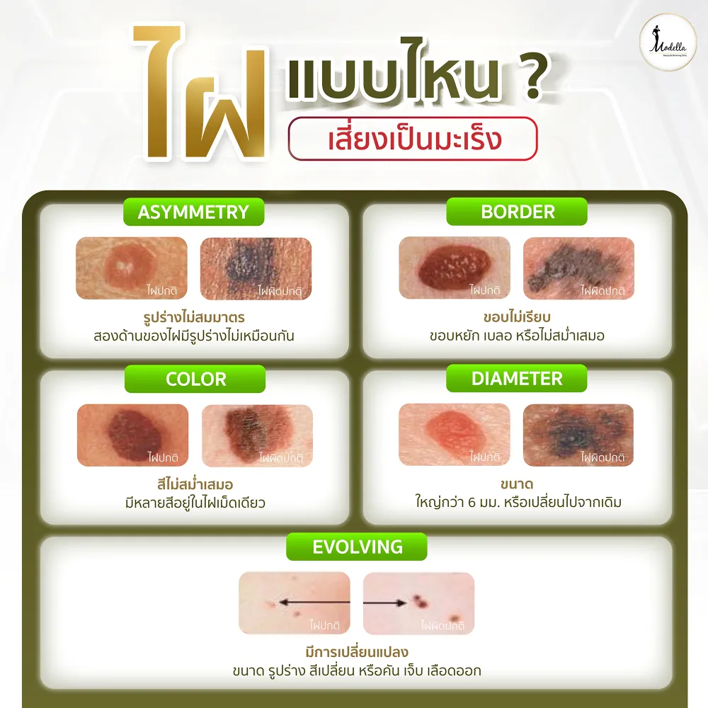 ไฝแบบไหนเสี่ยงเป็นมะเร็ง?