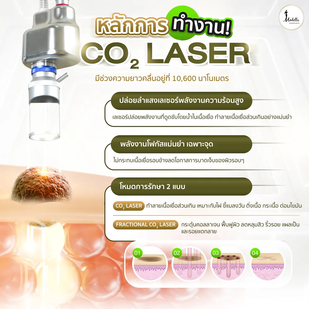 กำจัดไฝด้วย CO2 Laser คืออะไร และทำงานอย่างไร